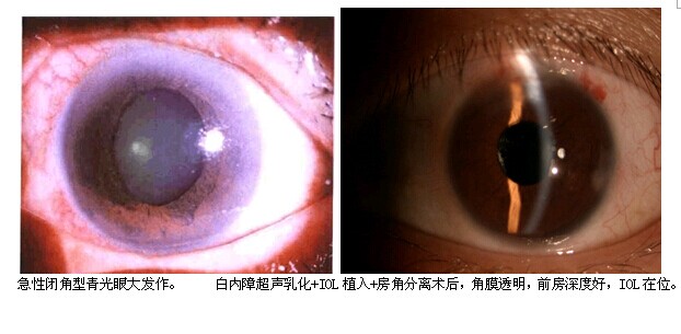 青光眼加白内障,一次手术解决两眼病