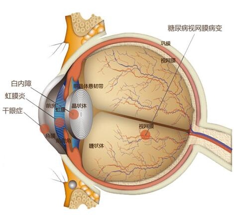 眼底出血是怎么回事