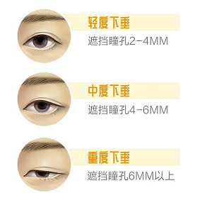 上睑下垂1.png